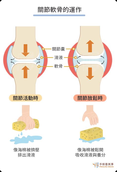 膝蓋長毛怎麼辦|【膝蓋軟骨磨損怎麼辦？ 退化性關節炎的軟骨再生治。